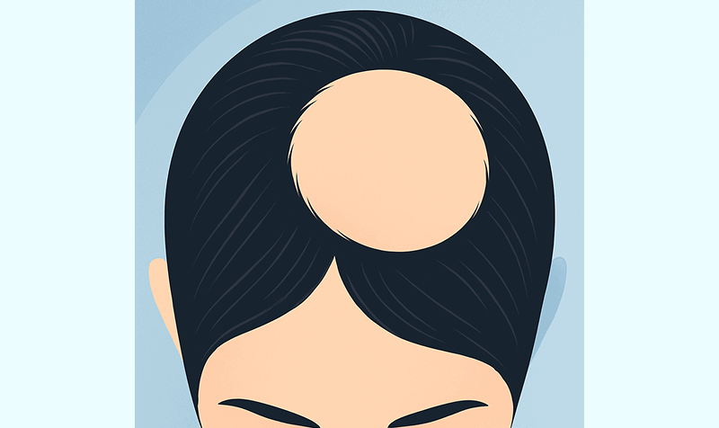 Illustration einer Kopfhaut mit kreisrundem Haarausfall, einem typischen Anzeichen für Alopecia Areata bei Männern.