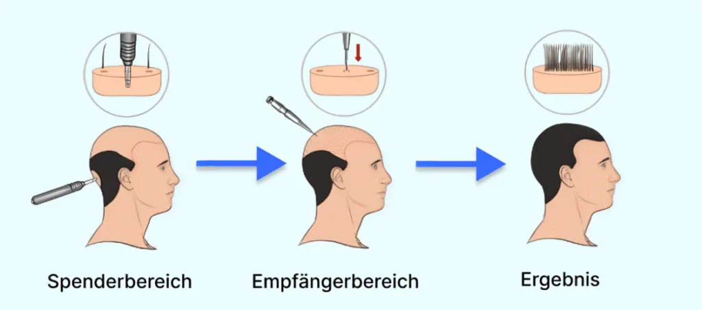 Schematische Darstellung des Ablaufs einer Haartransplantation bei Männern: Entnahme im Spenderbereich, Einsetzen im Empfängerbereich und das Endergebnis.