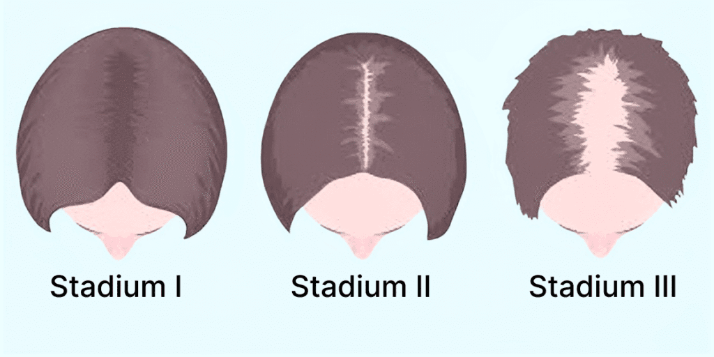 Illustration des Ludwig-Schemas, das die drei Stadien der androgenetischen Alopezie bei Frauen zeigt und den typischen Verlauf von Haarausfall Frauen darstellt.