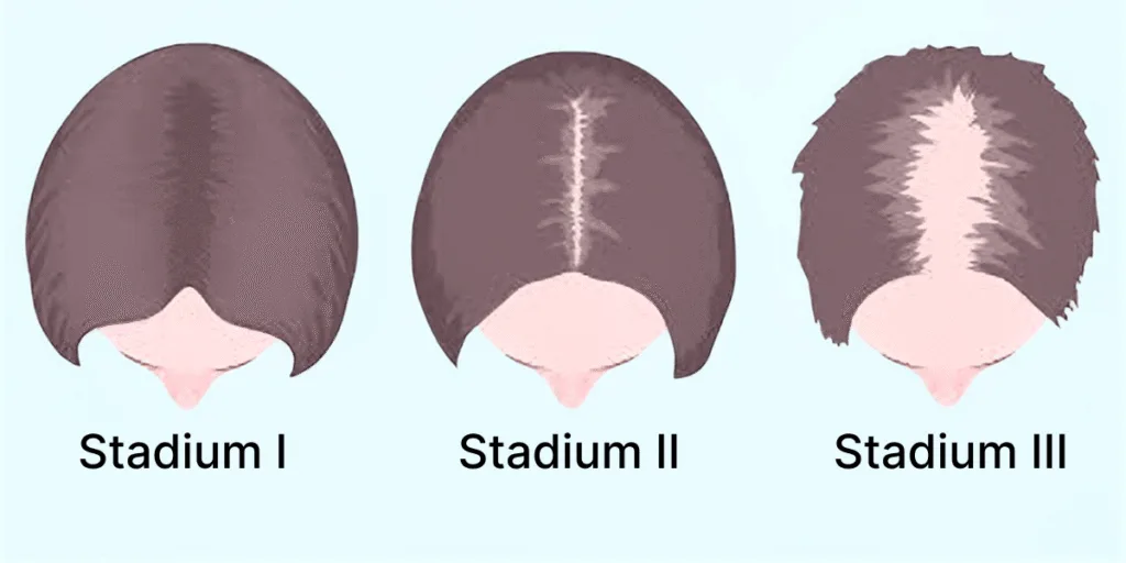 Illustration des Ludwig-Schemas, das die drei Stadien der androgenetischen Alopezie bei Frauen zeigt und den typischen Verlauf von Haarausfall Frauen darstellt.