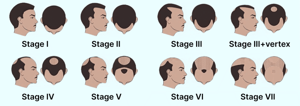 Illustration der Norwood-Hamilton-Skala, die die verschiedenen Stadien des männlichen Haarausfalls (androgenetische Alopezie) darstellt.