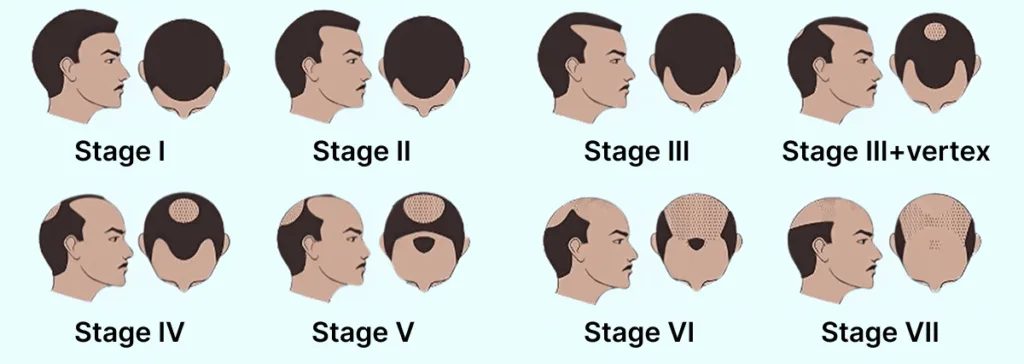 Illustration der Norwood-Hamilton-Skala, die die verschiedenen Stadien des männlichen Haarausfalls (androgenetische Alopezie) darstellt.