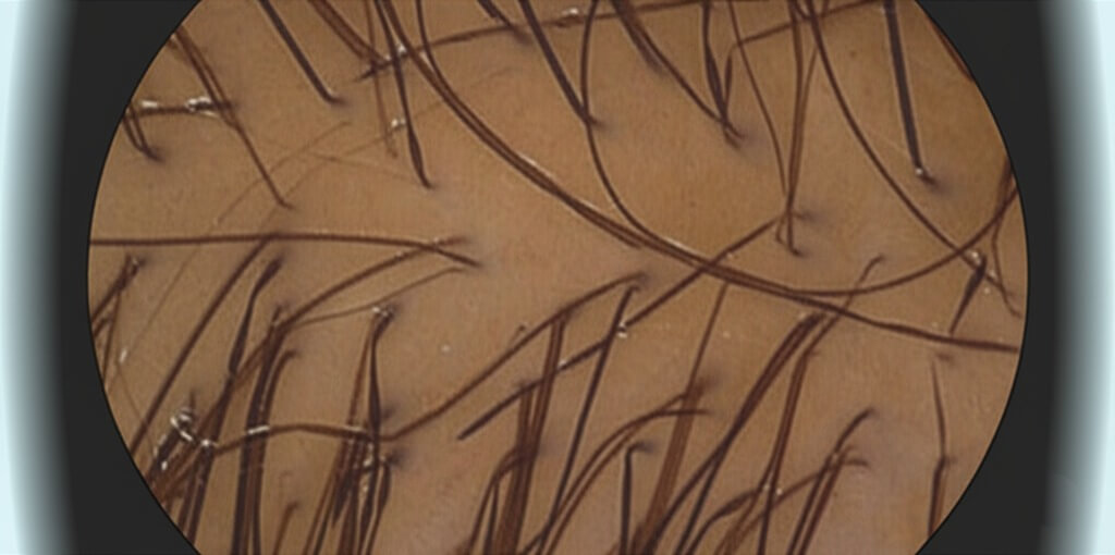 Simulierte Trichoskopie-Aufnahme der Kopfhaut, die Haarfollikel und Hautstrukturen zur Diagnose von Haarausfall bei Frauen zeigt.