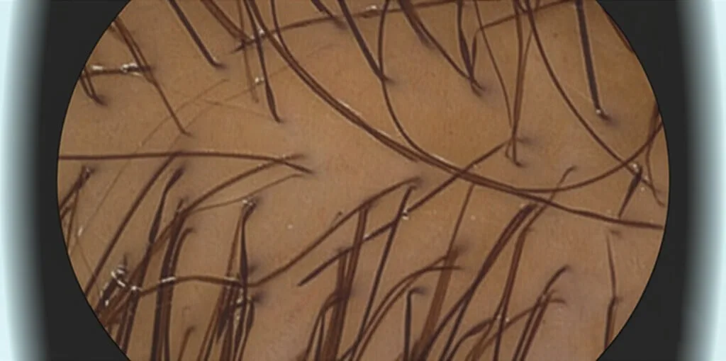 Simulierte Trichoskopie-Aufnahme der Kopfhaut, die Haarfollikel und Hautstrukturen zur Diagnose von Haarausfall bei Frauen zeigt.